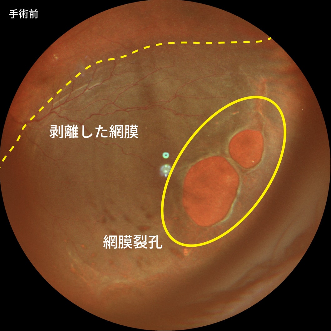 裂孔原性網膜剥離（強膜バックリングにより治療）　手術前