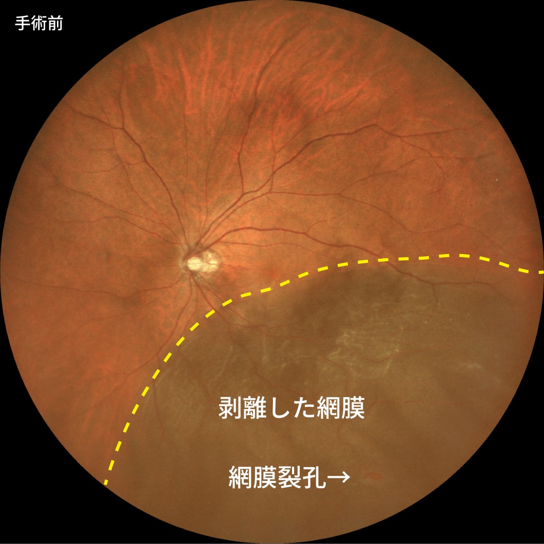 裂孔原性網膜剥離（硝子体手術により治療）　手術前