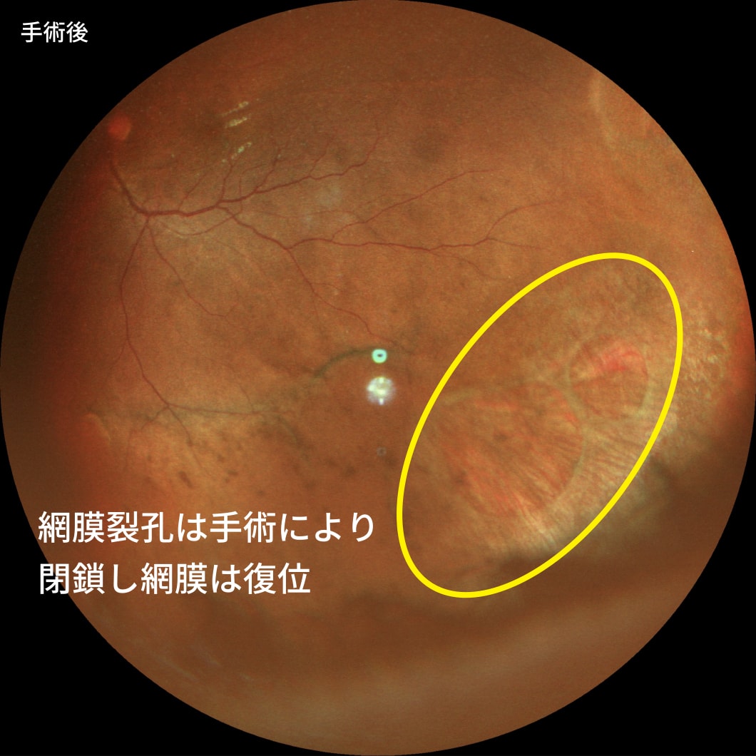 裂孔原性網膜剥離（強膜バックリングにより治療）　手術後